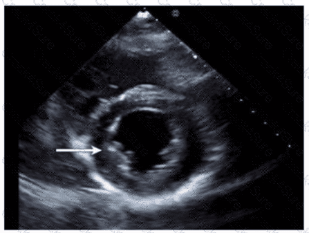AE-Adult-Echocardiography question answer