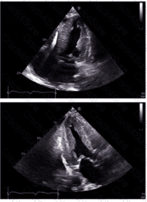 AE-Adult-Echocardiography question answer