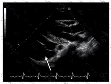 AE-Adult-Echocardiography question answer